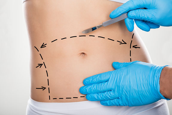Abdominoplastik Heilbronn